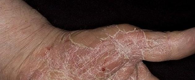 Effetti collaterali degli unguenti ormonali per la pelle.  Gli unguenti più efficaci per la dermatite allergica.