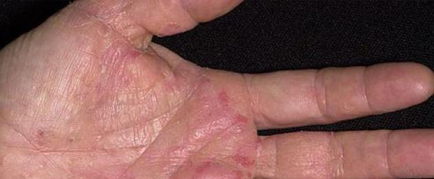 Macchia rossa con vescicole acquose.  Eruzione cutanea sulle mani sotto forma di bolle: cause e perché prude