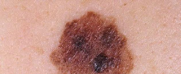 Жесткая шишка под кожей. Способы выявления заболеваний. Основные симптомы мягкой фибромы