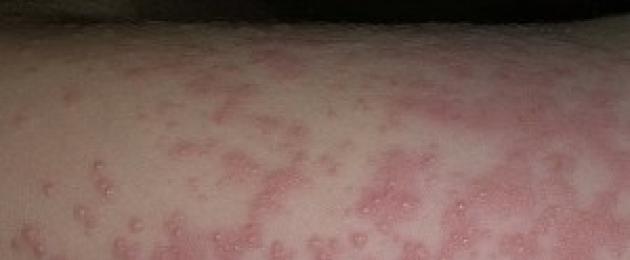 Вирус с кожными высыпаниями. Экзантемы — высыпания на коже, вызванные вирусными инфекциями