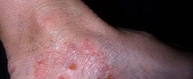 Экзема на пальцах ног — как вылечить дерматоз и устранить симптомы? Экзема на пятках — как проявляет себя патология, можно ли ее вылечить навсегда?