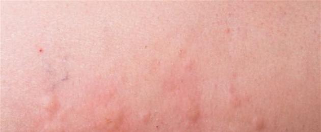 Красная сыпь у младенца по всему телу. Неинфекционные виды сыпи. Сыпь при энтеровирусной инфекции у детей фото.