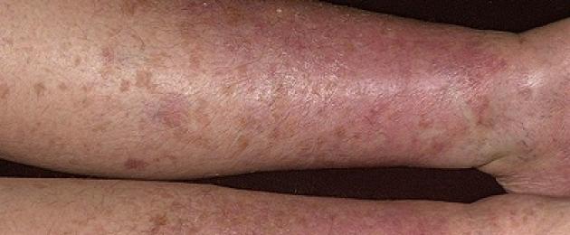 Инфекционный дерматит на ногах и руках. Варикозный дерматит и его лечение