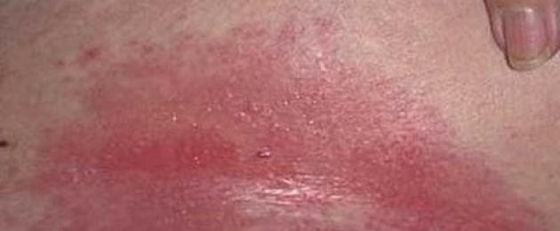 Malattie della pelle nei bambini di età inferiore a un anno.  Malattie della pelle infettive e non infettive dei neonati