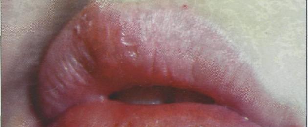  Стоматит на губе: формы, симптомы, причины, лечение