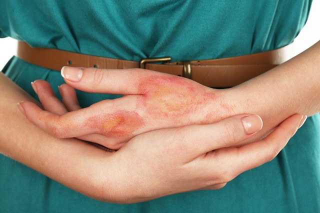 Аллергия на ладошках и чешется лечение thumbnail